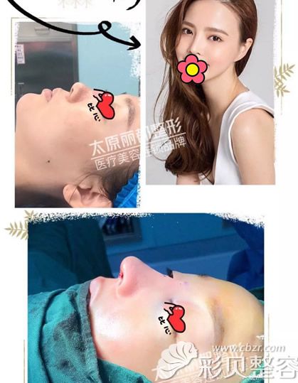 田建辉医生假体隆鼻+肋软骨隆鼻前后效果对比图