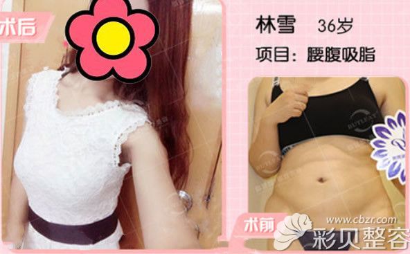 泉州脂管加邵起民腰腹吸脂效果案例 泉州脂管加邵起民腰腹吸脂效果案例