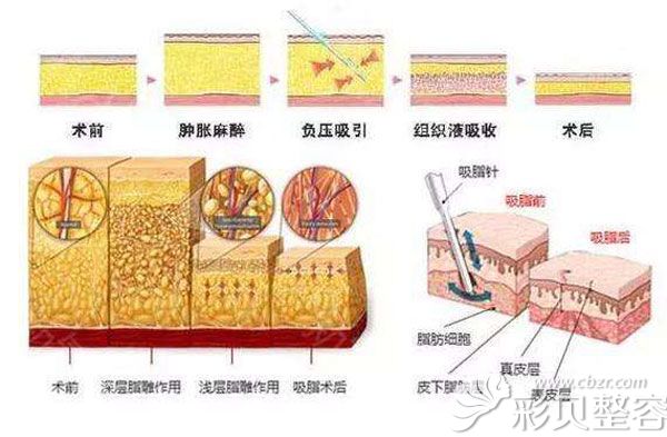 吸脂的过程介绍 吸脂的过程介绍