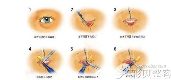 外切去眼袋多久能做2次修复