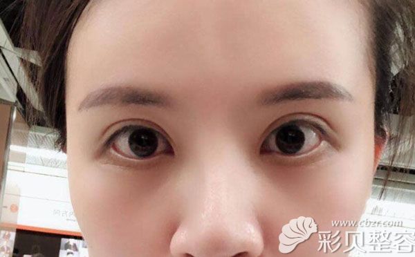外切去眼袋失败修复三个月后的效果图