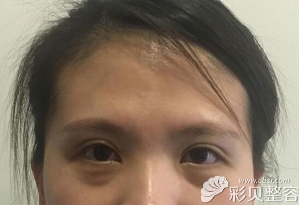 外切去眼袋手术失败下睑凹陷