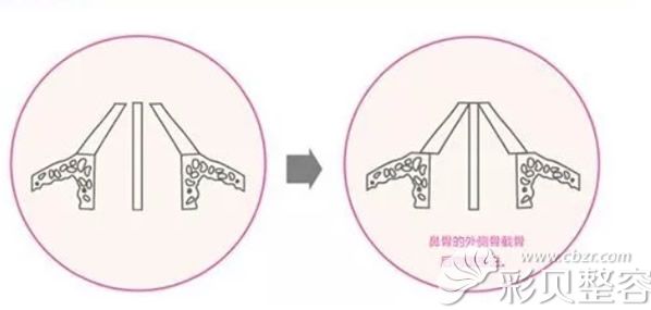 鼻背内推是大手术吗 多少钱 我做鼻骨内推价格元贵不贵 整容资讯 彩贝整容网