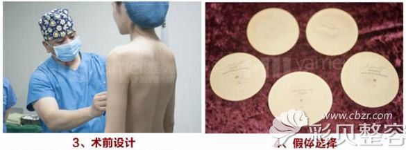 韩国艾恩隆胸修复