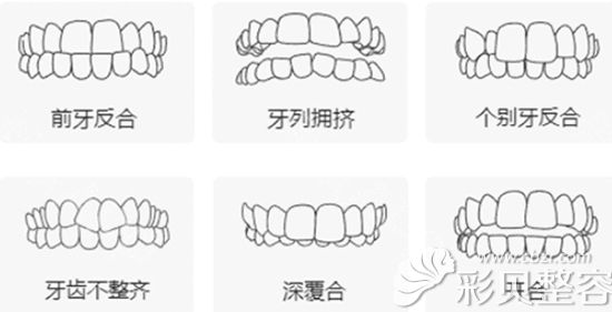 哪些牙齿适合做牙齿矫正
