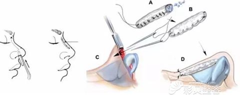 全肋软骨隆鼻 全肋软骨隆鼻