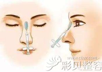 注射玻尿酸可以改善鼻型