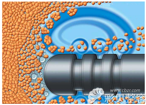 激光作用脂肪团