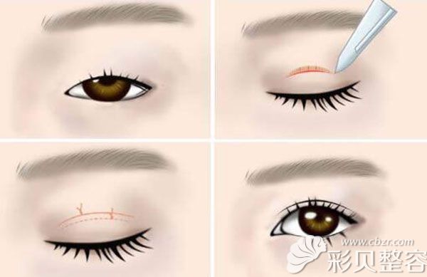 双眼皮手术过程示意图