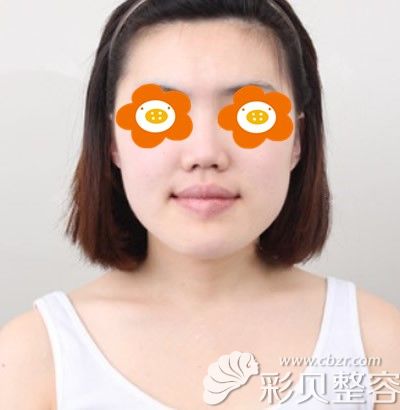 在韩国原辰做面部轮廓手术术前照