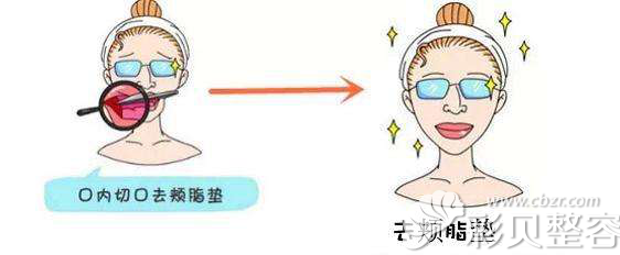 颊脂垫取出的位置