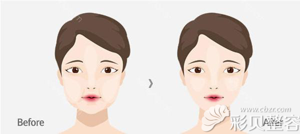 取颊脂垫术后对比图