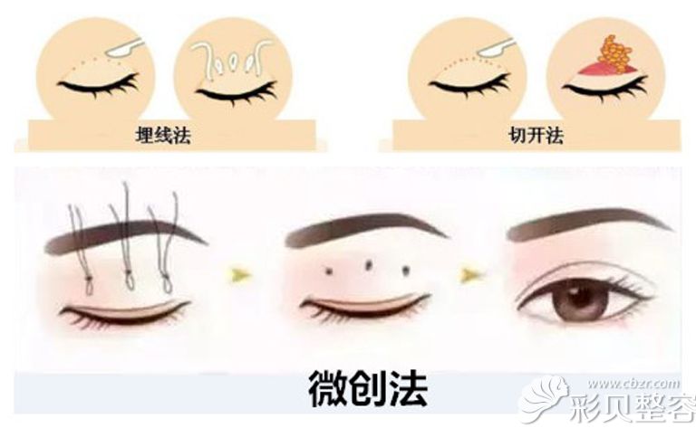 福州名韩察鹏飞讲目前常用的双眼皮术式