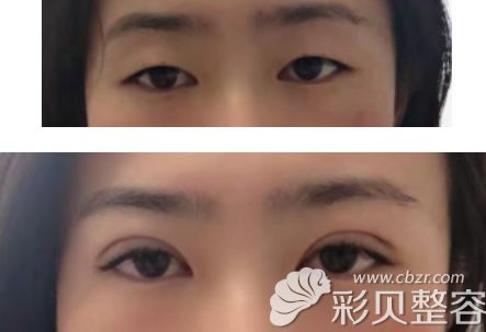 韩国ME双眼皮案例