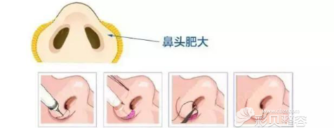 鼻翼过厚者鼻翼缩小手术方式