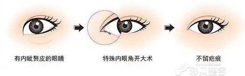 开内眼角示意图