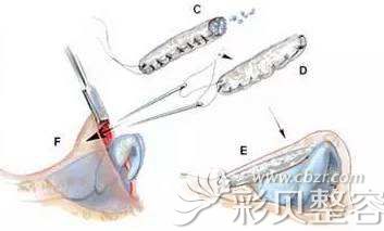 福州海峡薛克墘说做自体肋软骨隆鼻术后缝合仔细 福州海峡薛克墘说做自体肋软骨隆鼻术后缝合仔细