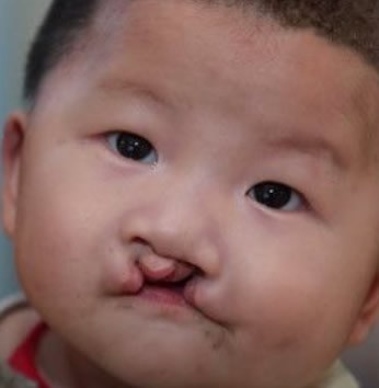 这是上海九院韦敏在苏州金阊医院免费做的唇腭裂修复案例!