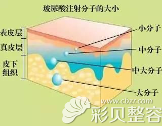 不同分子的玻尿酸注射皮下的位置
