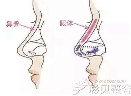海峡整形陈建忠医生说假体植入的位置