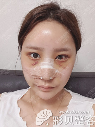 韩国艾恩金承俊埋线双眼皮+面部脂肪填充术后自然