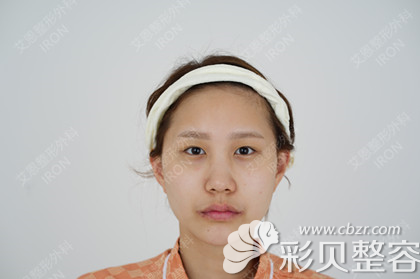 韩国艾恩埋线双眼皮+鼻综合+脂肪填充手术真人案例