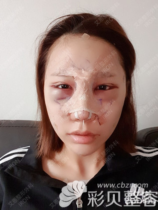 韩国艾恩埋线双眼皮提肌术后当天