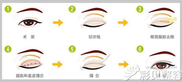 双眼皮手术操作过程图