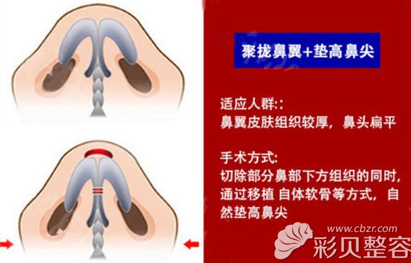 缩小鼻翼的方法