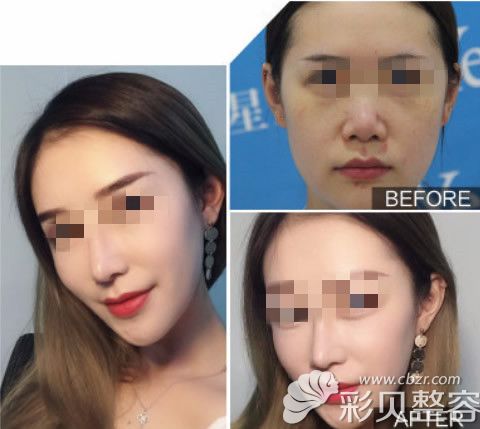 缩小鼻头鼻翼效果案例