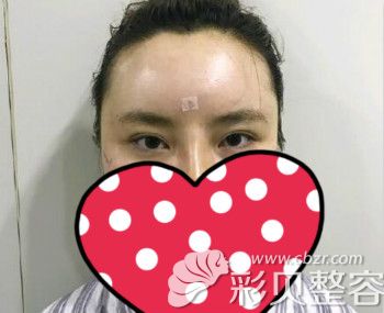 自体脂肪填充面部额头填过量