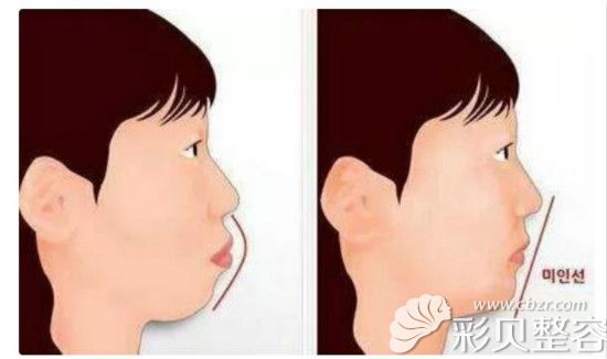 凸嘴与正常嘴侧脸效果 凸嘴与正常嘴侧脸效果