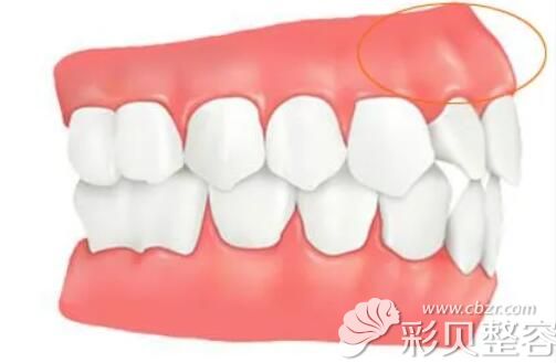 牙性凸嘴矫正方法及价格 牙性凸嘴矫正方法及价格