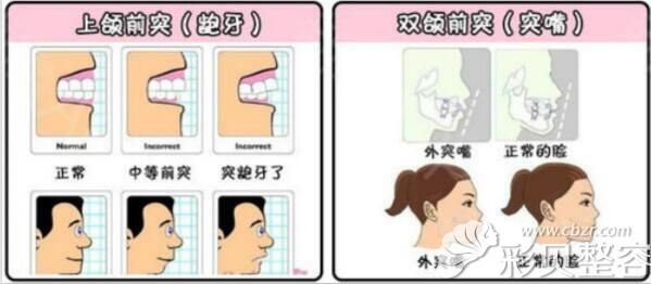 牙性和骨性嘴凸对比图 牙性和骨性嘴凸对比图