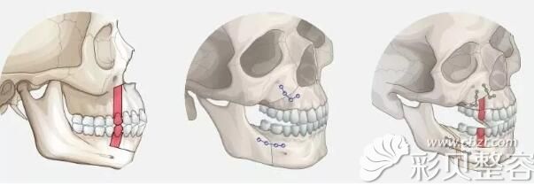 正颌手术矫正凸嘴效果示意图 正颌手术矫正凸嘴效果示意图