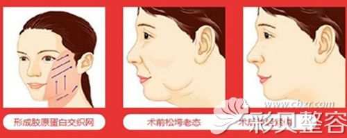 做面部埋线提升效果图 做面部埋线提升效果图