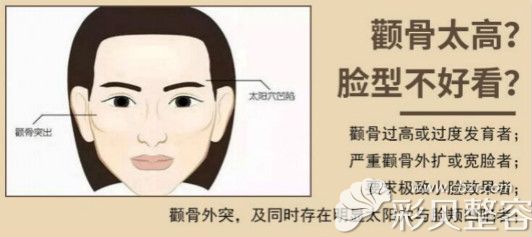 韩国磨颧骨技术好在哪里