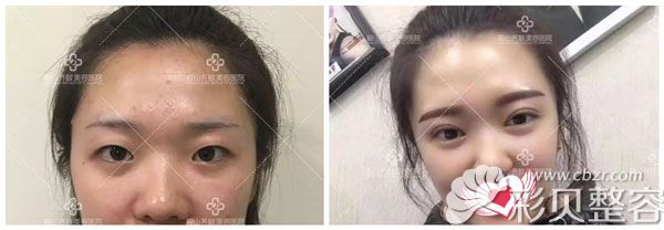 切开双眼皮2个月的前后效果对比图