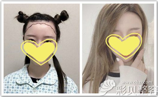真实案例：额头缩小术对比照片