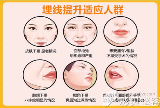 埋线提升适应人群