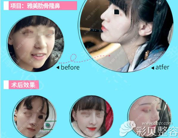 长沙雅美田方斌肋软骨综合隆鼻案例 长沙雅美田方斌肋软骨综合隆鼻案例