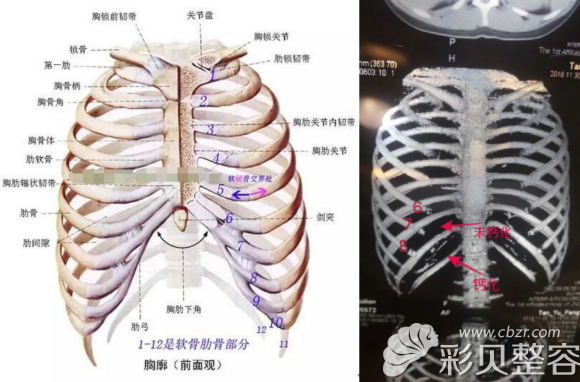 肋骨鼻需要拍肋骨ct