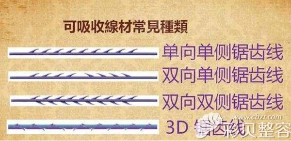 常见的可吸收线材形状