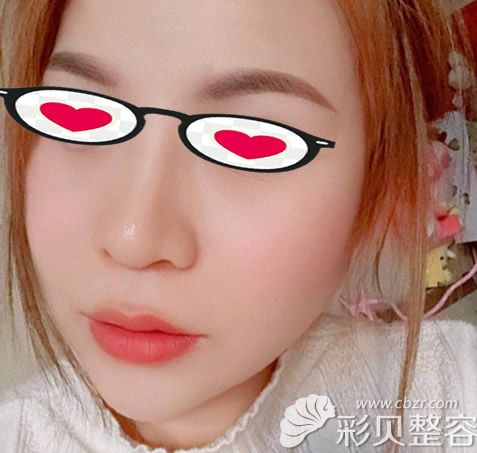 面部轮廓整形一年后效果 面部轮廓整形一年后效果