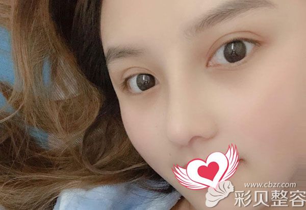 自体软骨一个月吸收的很少 自体软骨一个月吸收的很少