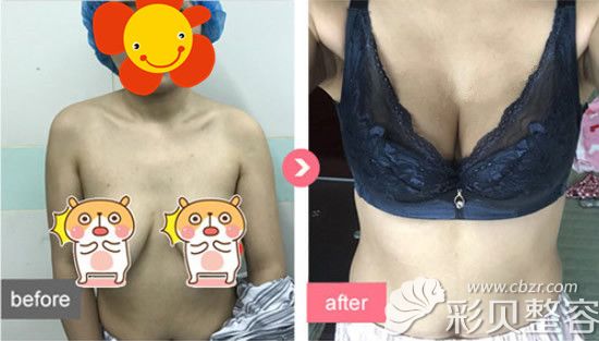 我做人工韧带乳房提升手术案例效果