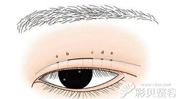 方文志医生做双眼皮手术的技术优势