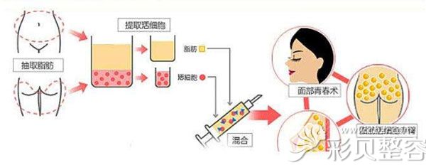 自体脂肪移植填充额头的技术优势