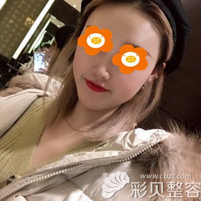 鼻综合术后3个月美照