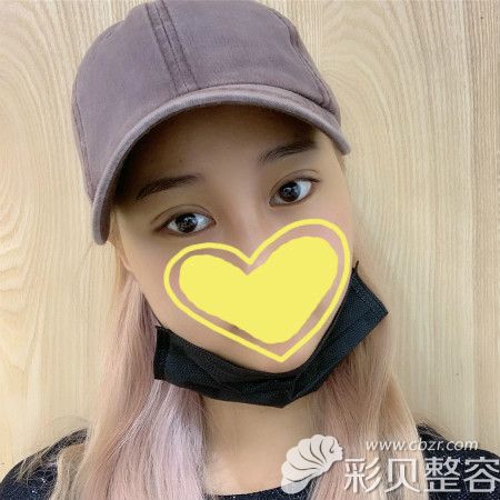 广州美莱陈贵宗双眼皮术后25天恢复效果图片